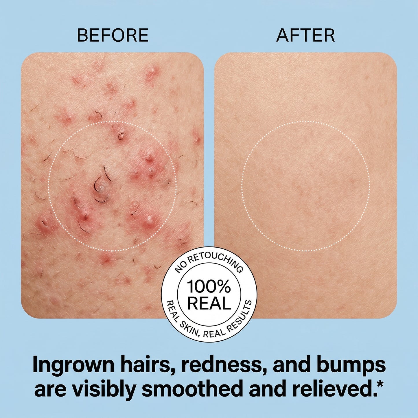 Dermellea Smoothing Solution Roll-On Treatment for Ingrown Hairs, Razor Bumps & Rough Post-Shave Skin